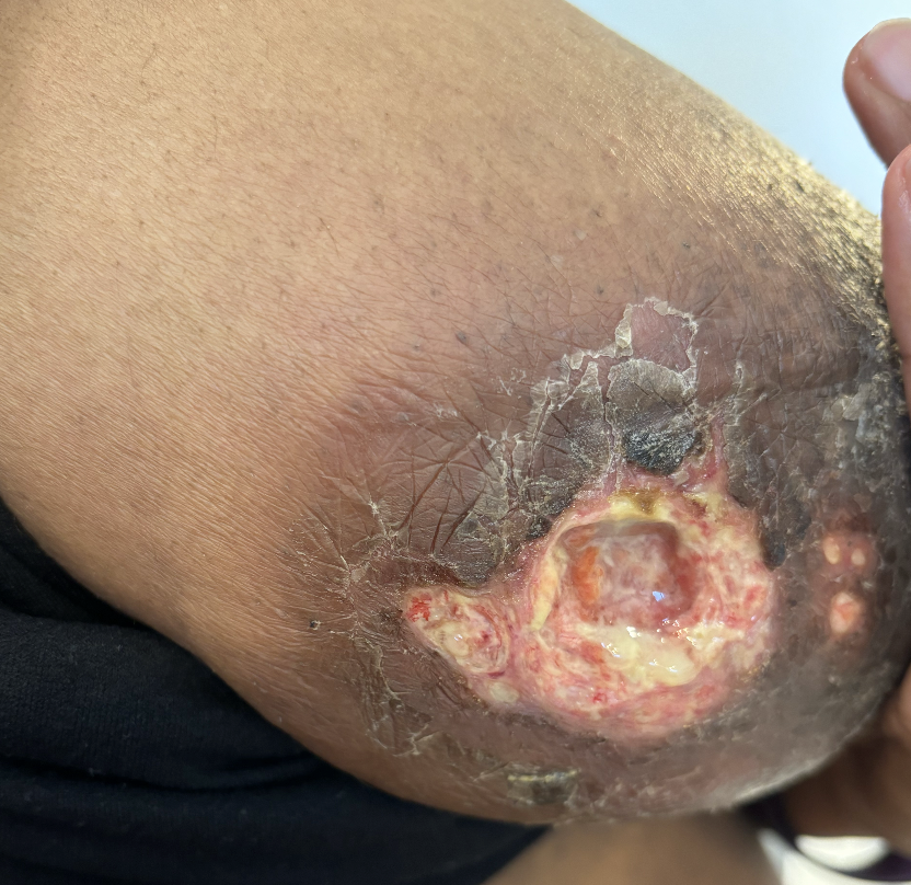 Initial massage damage right breast one month postpartum